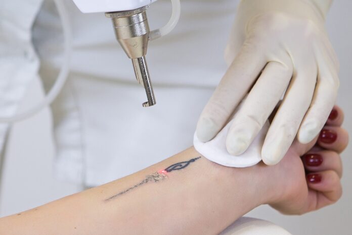 Laser Tattoo Removal
