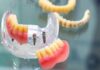 Mini Dental Implants: A Modern Approach to Comfortable, Convenient Tooth Replacement